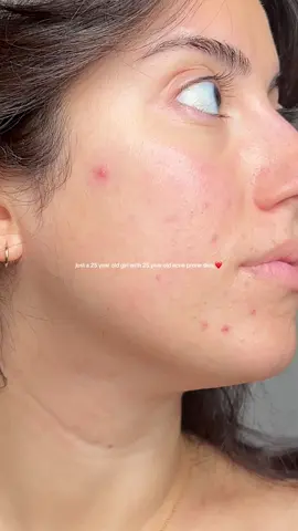 hair grows back, skin breaks out, and it’s okay ❤️