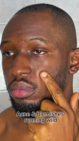 345 Reflief cream works! 😎 @Dr.Althea US #dralthea #345cream #fyp #acne #skincare 