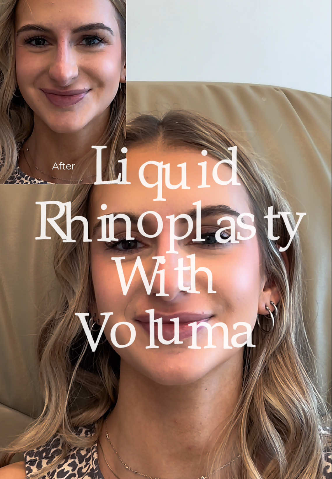 Instant refinement 👏 A liquid rhinoplasty with Voluma can: ✨ Lift / refine the nasal tip ✨ Conceal bumps / asymmetry ✨ Create a smoother bridge ✨ Make the nose appear more narrow Performed by Dr. Ben Stong, double board-certified facial plastic surgeon — immediate results and no downtime. 📍 Kalos Facial Plastic Surgery | Atlanta, GA 📞 (404) 963-6665 🔗 kalos-plasticsurgery.com #ksthetics  #btcplasticsurgeon  #liquidrhinoplasty  #nonsurgicalnosejob  #voluma 