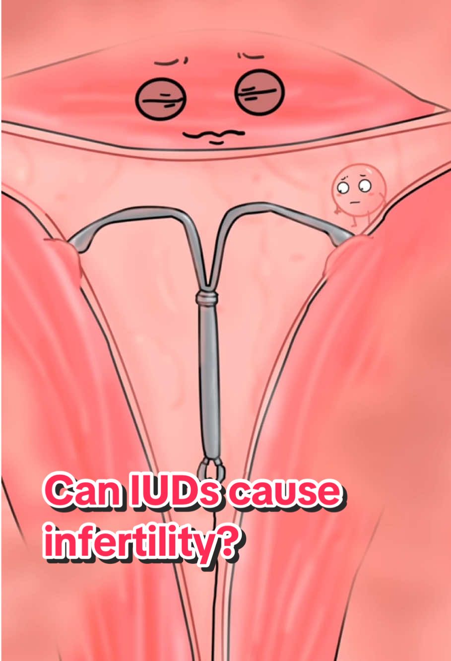 Can IUDs cause infertility?#healthy #animation 