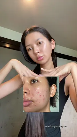 ลองดู #แผ่นแปะซิลิโคนเจล #แผ่นแปะซิลิโคน #ส้มโอที่หน้าเป็นสิว #ใช้ดีบอกต่อ #ป้ายยาtiktok 