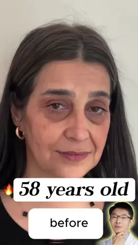 Kamahalan ang impecableng kutis gamit ang aming Bee Venom Face Cream! Gawa sa natural na mga sangkap, ito ay nagha-hydrate at nagpapanariwa ng iyong balat. Idinisenyo ito para magpakinis at magpafirm, isang nakapagpapalusog na treatment na tumutulong para mas umelastic at gumanda ang texture ng iyong balat. Pwede mong i-click 'yung product link sa right-bottom ng ad, o kaya check out mo sa shopping cart sa aking homepage! May discount! #botox #botoxcream#TikTokPhilippines#PinoyTikTok jr1106-3