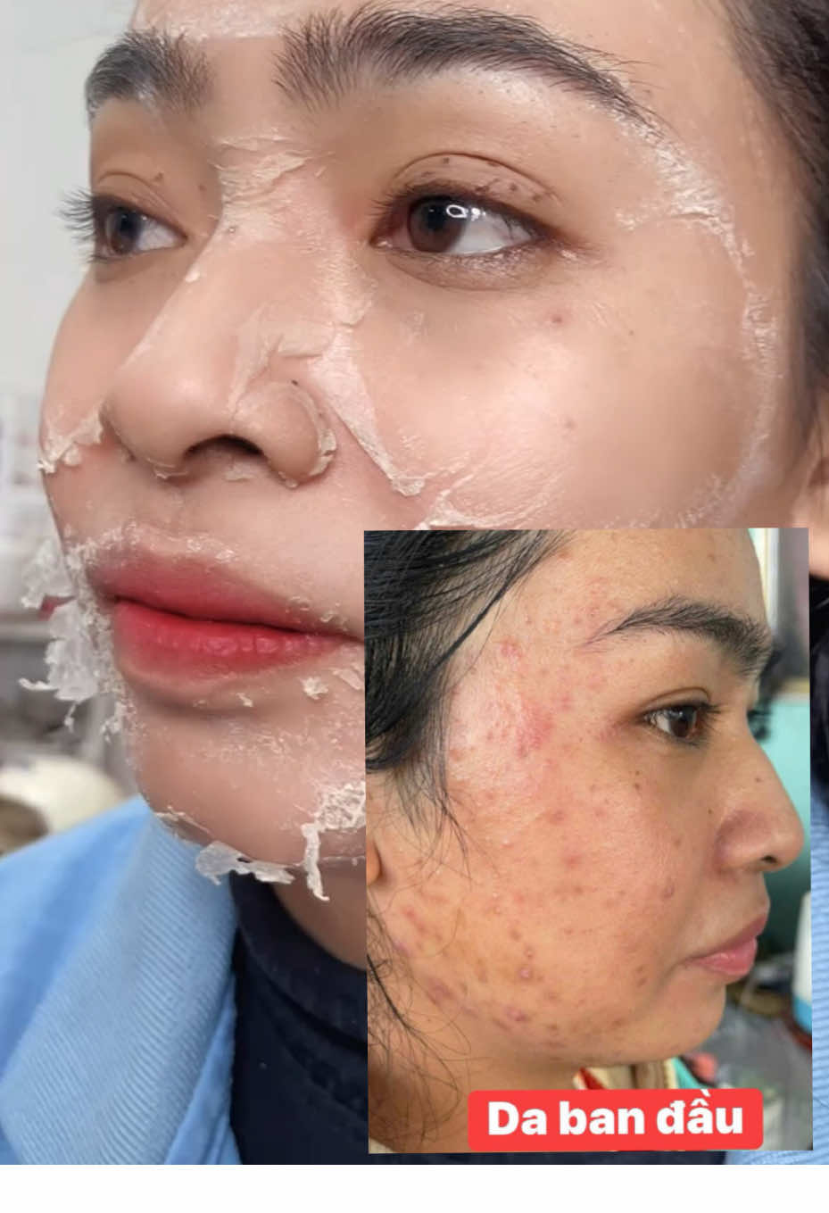 Tinh chất peel da hút sắc tố nám mụn tàn nhang