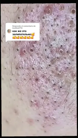 Respuesta a @koshka2710 #additive 😩😩🍧🍦#oddlysatisfying #SKinCare #ASMR #pimplepoppinvideos🤔😓😓 @VladimirThurein ( ရဋ္ဌပါလ ) 