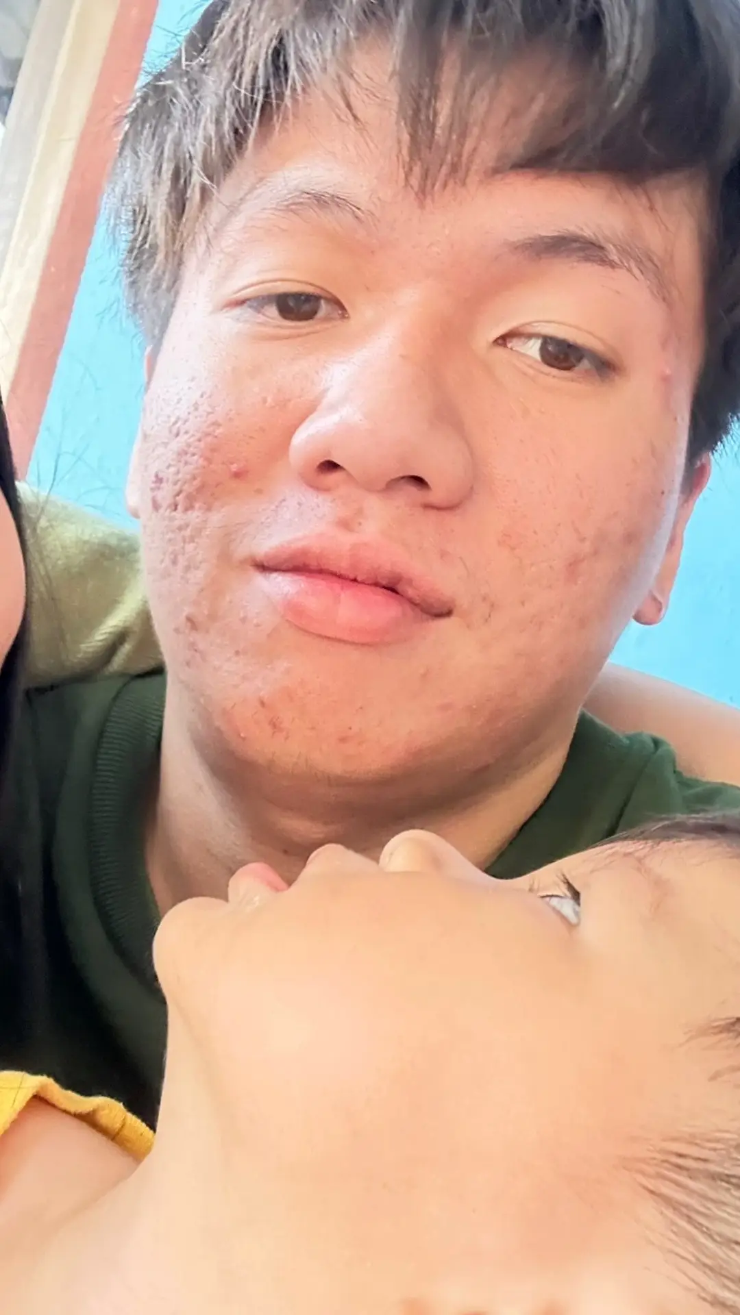 กว่าจะหายไม่ใช่เรื่องง่าย #ปาเนร่าครีม #สิว #สกินแคร์ที่ใช้ 