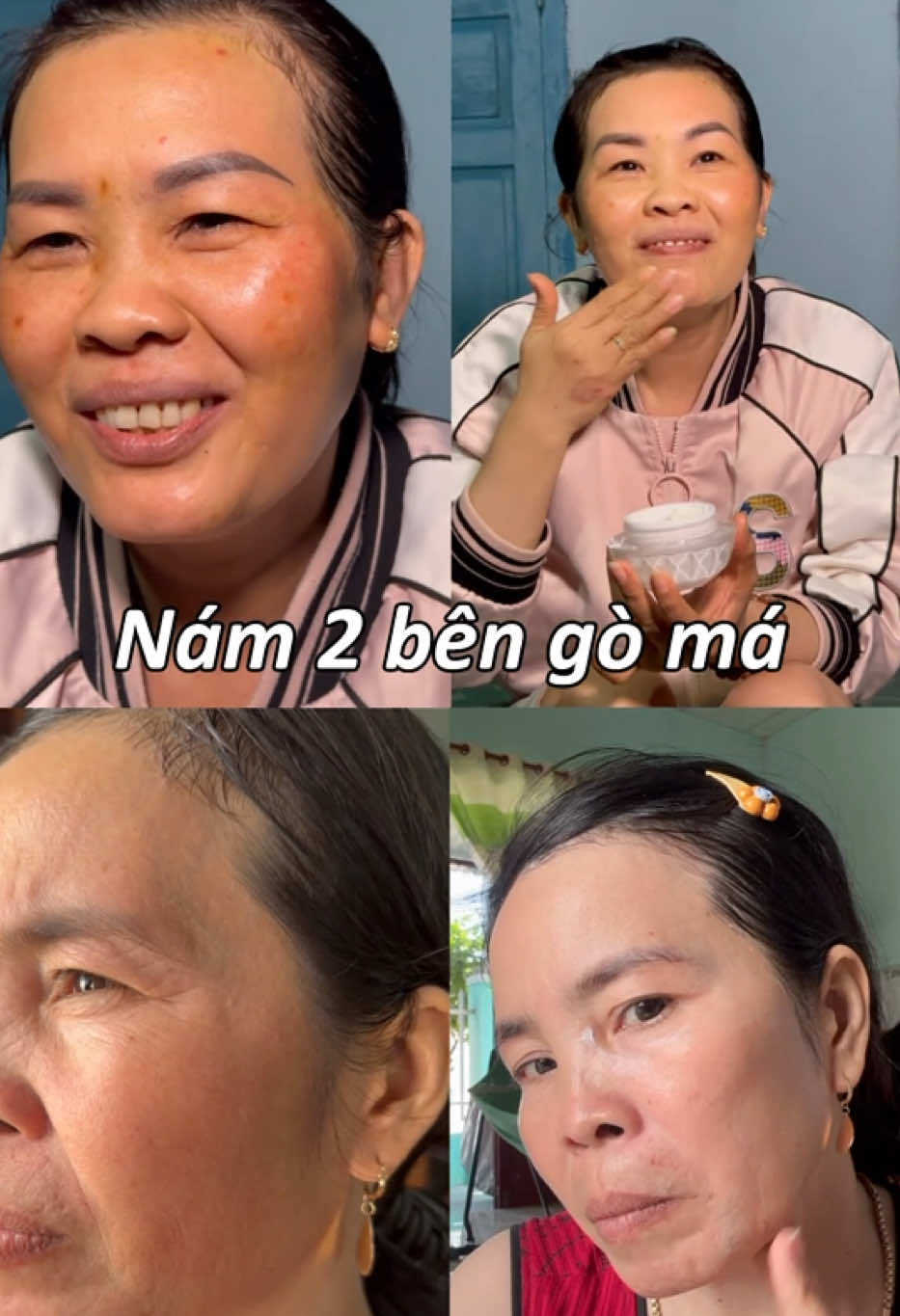 Kiên trì sử dụng, nám sẽ mờ đi dần dần. Cải thiện nám tại nhà an toàn, hiệu quả không cần xâm lấn @Comi VietNam #comivietnam #kemnam 