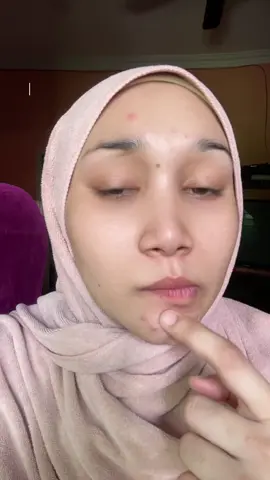 Ni hasil lepas 8 hari je pakai Oilet Serum 🥹 Jerawat dah kecut, parut pun makin pudar 😍 #elegantcosmeticshq #oiletserum #skincarejourney #acneprone  