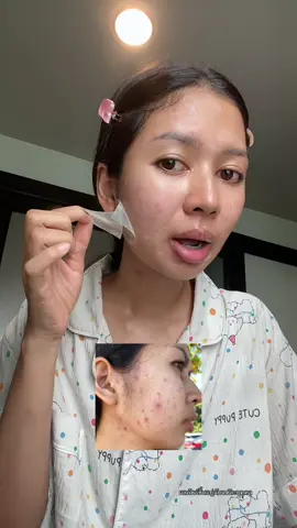 ลอกออกแบบจึ้ง!! 😍 #ส้มโอที่หน้าเป็นสิว #แผ่นแปะซิลิโคน #แผ่นแปะซิลิโคนเจล #ใช้ดีบอกต่อ #ป้ายยาtiktok 