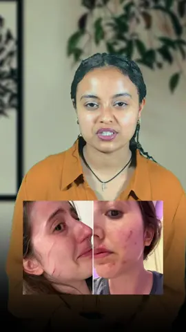 #scar #scarsheet  #siliconesheet 