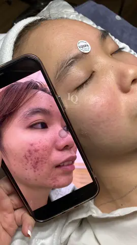 Cập Nhật da Mụn Sẹo #chamsocdamun#chamsocdaseo#chamsocdanam#tanbinh#Lqspa&academy
