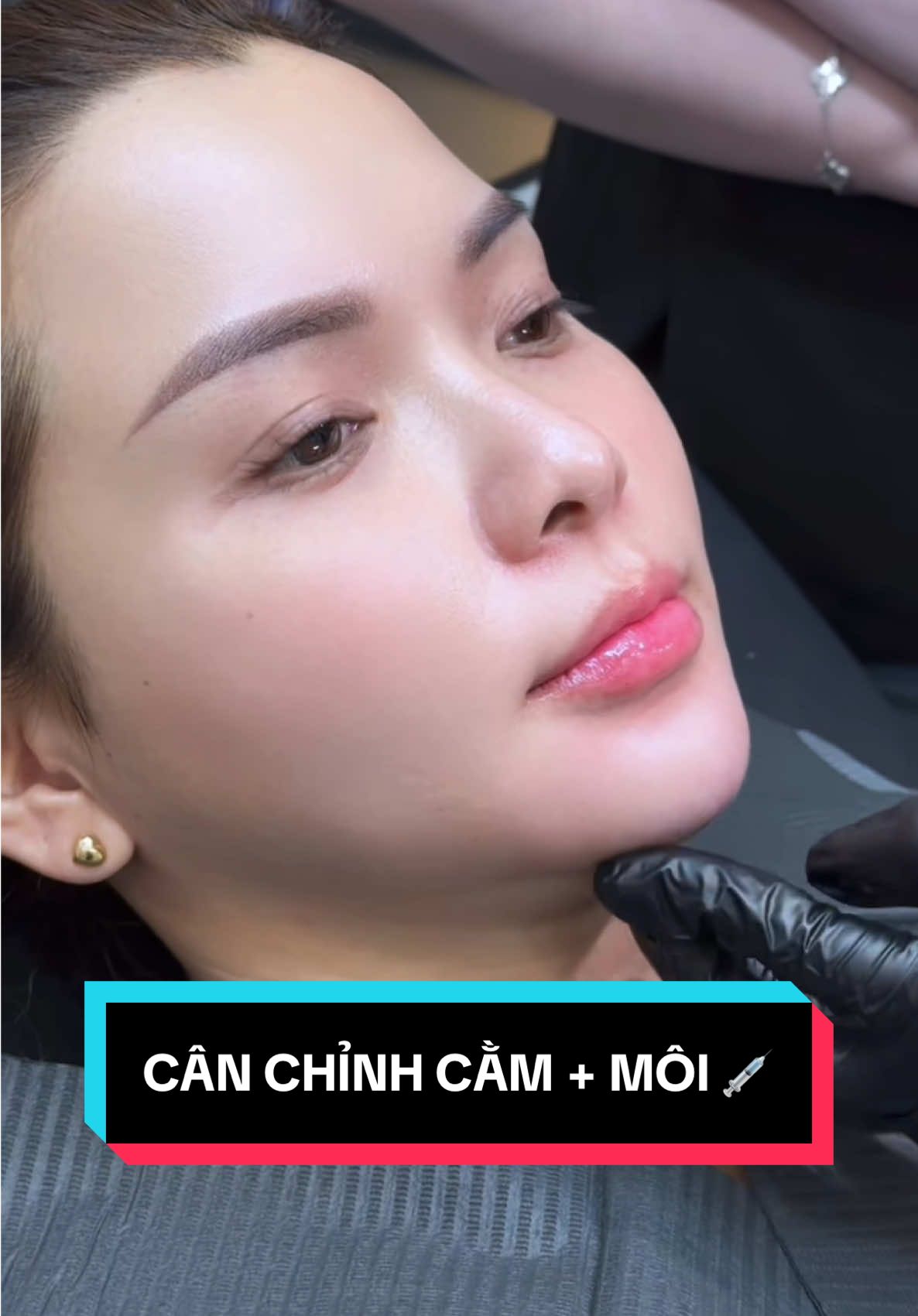 Cân chỉnh môi + cằm lệch cho bé khách nhà TienLe 💉💖 #TienLeAcademy #botox #tienleacadamy #filler 