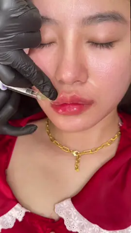 Tiêm tí khoé tạo điểm nhấn nè mấy ní ơi #fillers💉 #lamdep #haiphong #botox #thammy 