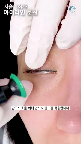 망한 아이라인 문신제거  [Laser Tattoo Removal] #문신제거 #tattoo #tattooremoval ▼▼하찮은 문신 신청하기▼▼ https://forms.gle/FJSCNf5itr6ZoWow6 모든 시술은 기본적으로 수면마취로 진행합니다. 마취통증의학과 와 성형외과 전문의 더블보드를 가지고 있어 비교적 안전한 수면마취가 가능합니다. 통증 때문에 시술을 꺼려하시는 분들은 언제든 문의주세요.