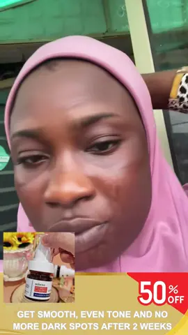 Qw Hyperpigmentation Solution...  Try aobenz serum here!#foryou #spots #fyp 