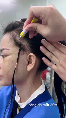 căng da mặt 20tr..