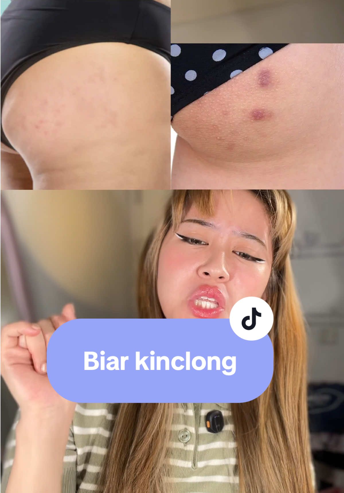 Biar kinclong sebadan badann #BekasLuka #Ruam #CreamBekasLuka #CreamGatal #CreamIritasi 