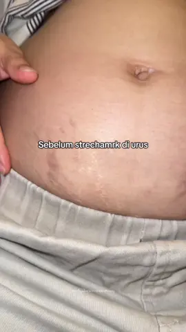 Cukup 3 step strechmark bisa samar tak terlihat #fyp #strechmarks #ciaraindonesia 