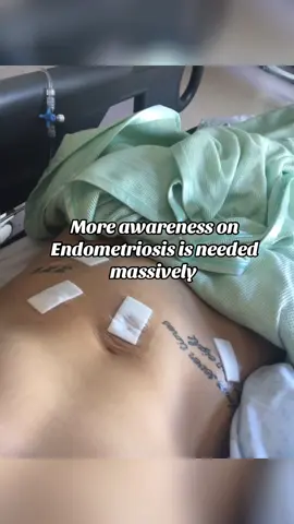 More awareness is desperately needed. #endometriosisawareness #fyp #endometriosis #adenomyosis 