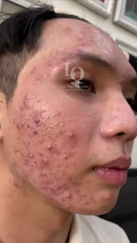 Cập nhật da mụn thâm #chamsocdamun#chamsocdaseo#chamsocdanam#tanbinh#Lqspa&academy 