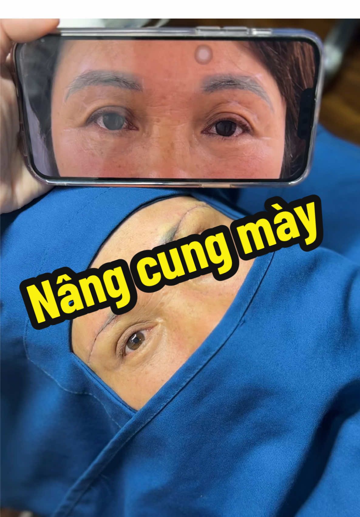 Cứ sụp da lại đến gặp e.  C khach đau đầu vì cặp lông mày trổ xanh , hút 8 lần lazer nơi khac bị sẹo và chai nền .  Pp nâng cung là lựa chọn tối ưu nhất để ổn định sau 1 tháng sẽ lên đc dáng mày mới như mong muốn .  #thammyslee #Nângcungchânmày