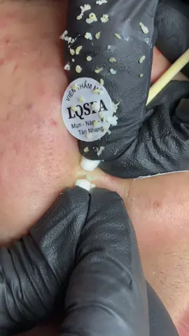 Tăm bông #chamsocdamun#chamsocdaseo#chamsocdanam#tanbinh#Lqspa 