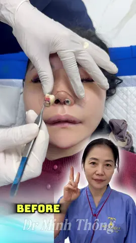Hasil Operasi Facelift, Rhinoplasty, dan Pengecilan Bibir #rhinoplasty #trending #drthông #hidung #master2025bytiktok 