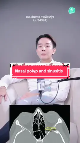 Optic nerve injury  #หมออ้นฉัตรพล  #หมออ้นidl  #หมออ้น  #idlhospital  #ริดสีดวงจมูก 