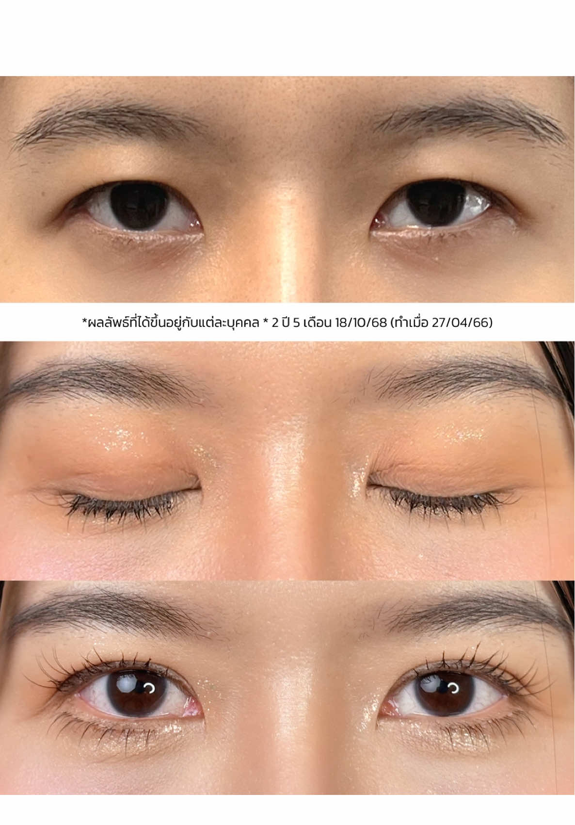 ครบ 2 ปี ตายังสวยเป๊ะ💖👀 #รีวิวตาสองช้้น #หมอสกาย #skyclinic #จักษุแพทย์ #ทำตาที่ไหนดี 