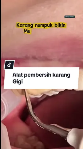 “Gak perlu ke dokter buat scaling! 😁 Cukup pakai Airidu Ultrasonic Dental Scaler — karang gigi langsung rontok, senyum makin pede! ✨🦷 #AiriduDentalScaler #AlatPembersihGigi #ScalingGigiRumahan #dentalcare 