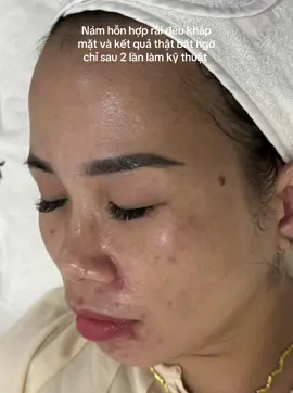 Khi làm da được lắng nghe , kết quả luôn làm bạn hài lòng #Thuỷ_Venus_chuyên_trị_nám #chuyên_giải_quyết_các_vấn_đề_về_da #nám_chân_sâu_bớt_hori #giải_quyết_vấn_đề_mụn_nám_sẹo 