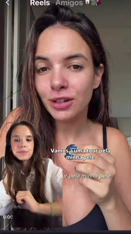 A acne não é apenas um problema da adolescência. Embora afete mais de 80% dos adolescentes, também é uma realidade para muitos adultos. E, mais do que uma questão de pele, é uma fonte de insegurança que pode impactar profundamente a autoestima e a vida social. É um tema que continua a ser muito importante para mim — vivi de perto o desafio da acne na adolescência, e sei bem o quanto pode marcar. Um estudo publicado em fevereiro de 2024, no Journal of the American Academy of Dermatology (JAAD), confirma esta realidade: mostra a estigmatização e as dificuldades emocionais expressas por pessoas com doenças de pele visíveis nas redes sociais. Entre todas as condições analisadas — eczema, psoríase, vitiligo e rosácea — a autoimagem das pessoas com acne foi a mais afetada. O estudo destaca o impacto psicológico de lidar com borbulhas recorrentes e com a frustração de novos surtos que parecem nunca terminar. Se tens acne — seja na adolescência ou na vida adulta — não estás sozinho. E lembra-te: não existem peles perfeitas. Existem peles reais, com histórias, fases e imperfeições. Obrigada @mafalda.sampaio por seres uma voz tão ativa!