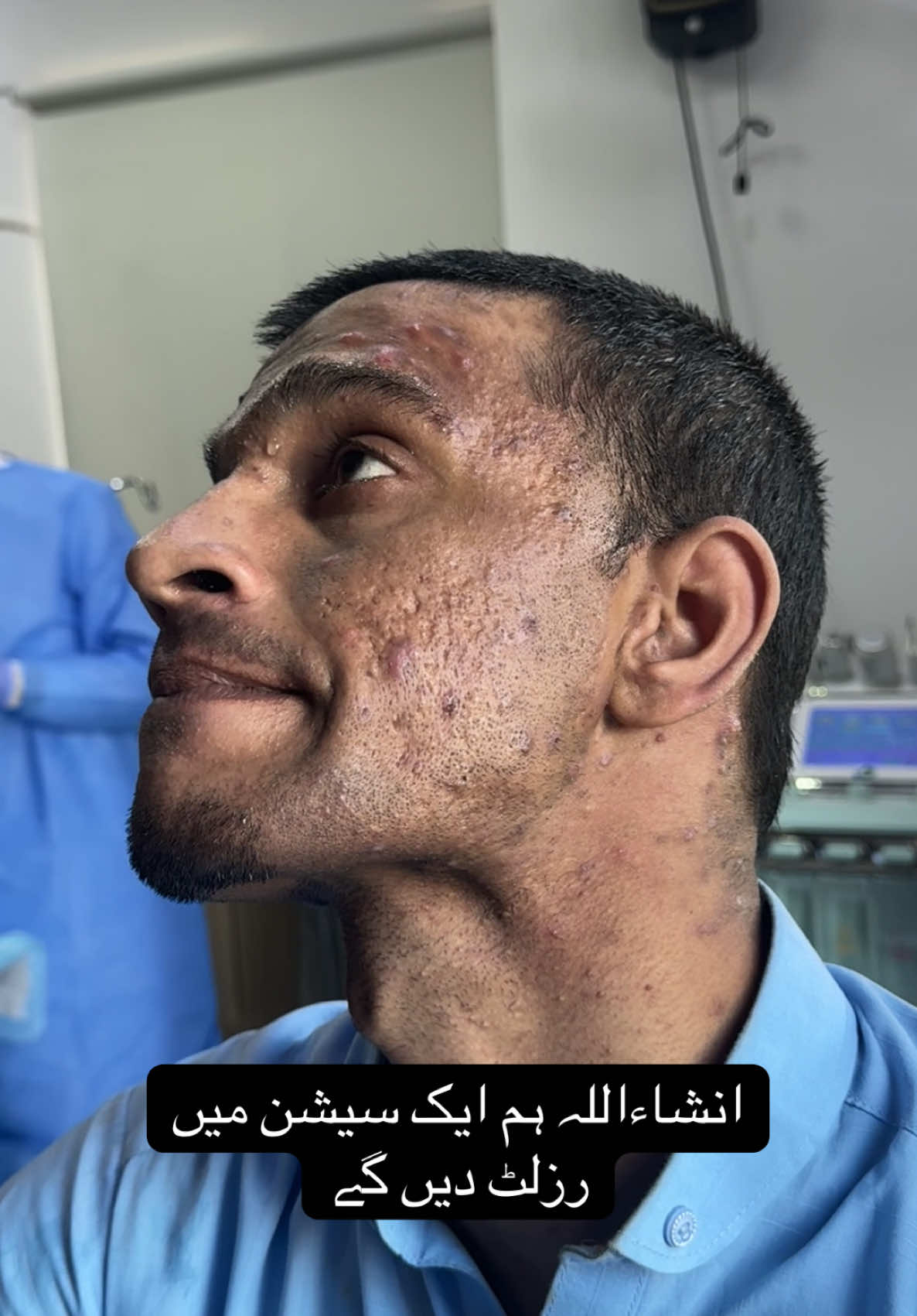 Acne scars best treatment in Pakistan #foryou #bestdoctorforacnescars #treatment #acnescarstreatment #acnetreatment #acne #acnescars #acnetreatmentbestdoctor 