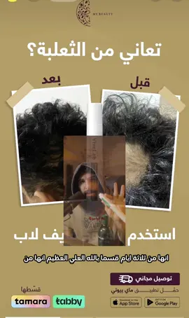 كود الخصم:RAS1 @My Beauty | ماي بيوتي  تعاني من ثعلبه ما لك الى ماي بيوتي#اكسبلور #الشعب_الصيني_ماله_حل😂😂 #سيروم 