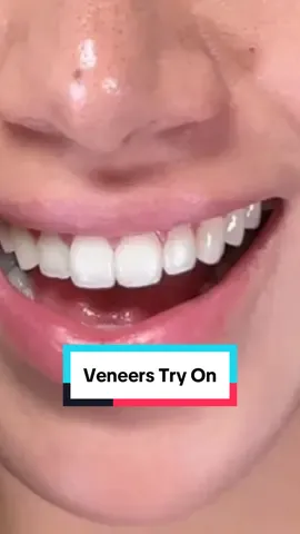 Veneers Try On #veneers #dentist #smiletransformation #newsmile #teeth 