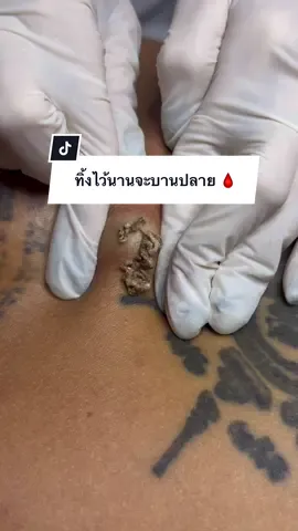 อย่าทิ้งไว้นานจะบานปลาย 🥴😤#ลดายุกดสิวสุราษฎร์ธานี #ดูแลโดยผู้เชี่ยวชาญ #ร้านกดสิวสุราษฎร์ธานี #คลิปกดสิว #ขึ้นฟีดเถอะ 