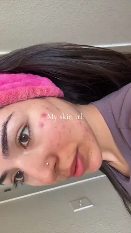 #dontbelieveeverythingyouthink #morning #foryoupage #skin #acne 