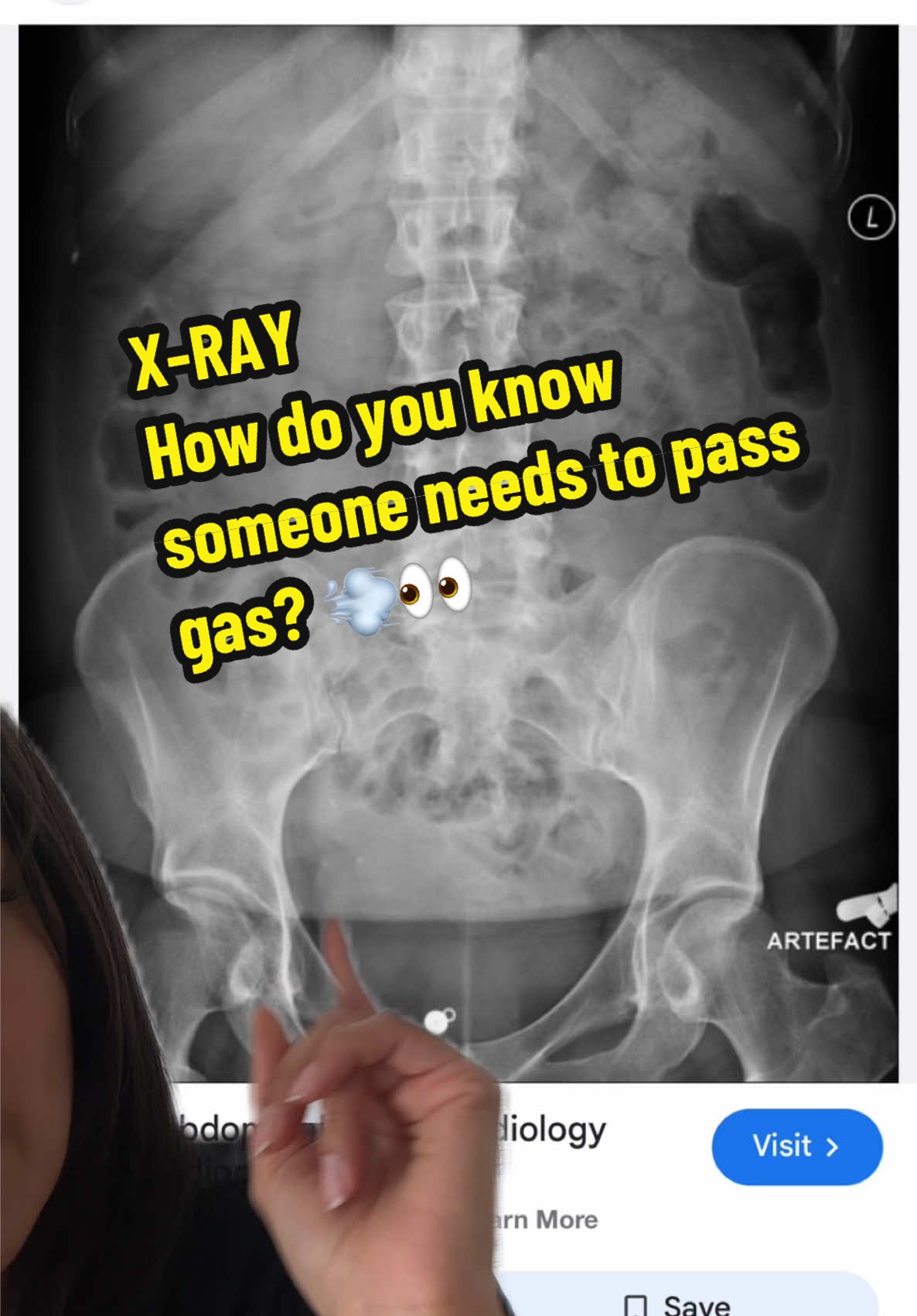Replying to @kip #greenscreen X-ray questions! How do you know from an x-ray that somebody needs to pass gas? 👀  #xray #xraytech #radtech #radiologictechnologist 