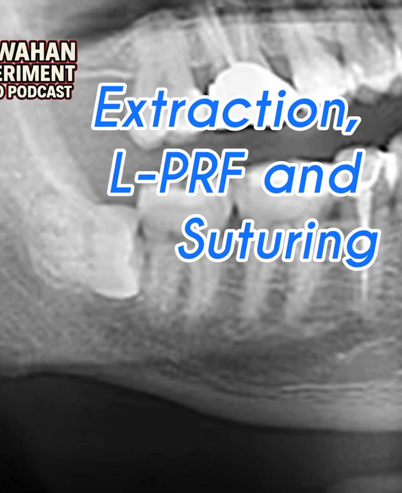 Incomplete split and L-PRF and Suturing in this one #wisdomteethremoval #wisdomteeth #dentalinfluencer 