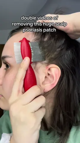 One Wonderful Night was so well done i loveeeee🩷 #scalppsoriasis #psoriasis #psoriasisawareness #scalppsoriasisremoval #psoriasistok 