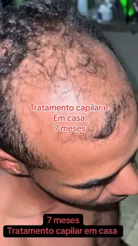 #fyppppppppppppppppppppppp #crescimentocapilar #calvice #cabelo #fyp 