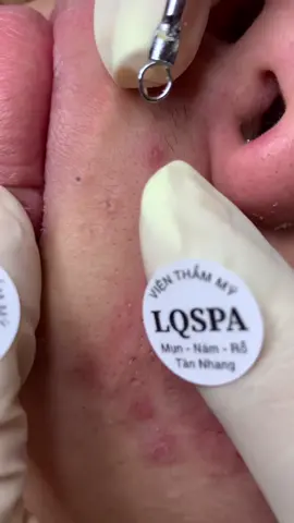 Ngứa lắm lấy giúp em #chamsocdamun#chamsocdaseo#chamsocdanam#tanbinh#Lqspa&academy
