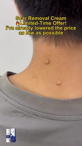 #scar #fyp #tiktopshopblackfriday #acne #scarremover 
