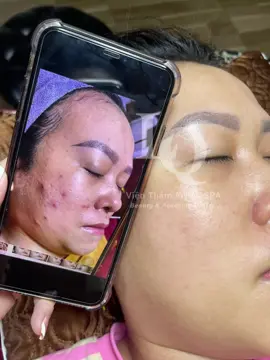 Cập nhập da khách #chamsocdamun#chamsocdaseo#chamsocdanam#tanbinh#Lqspa&academy