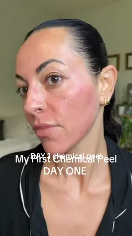 let’s even out that melasma and hyperpigmentation with the enlighten peel #chemicalpeel #antiaging #antiagingskincare #skincaretips #matureskin  @OBAGI MEDICAL SKINCARE eyebrow serum @Dr. Whitney Bowe @DWB Beauty lip treatment  @ColorScience flex tinted sunscreen 