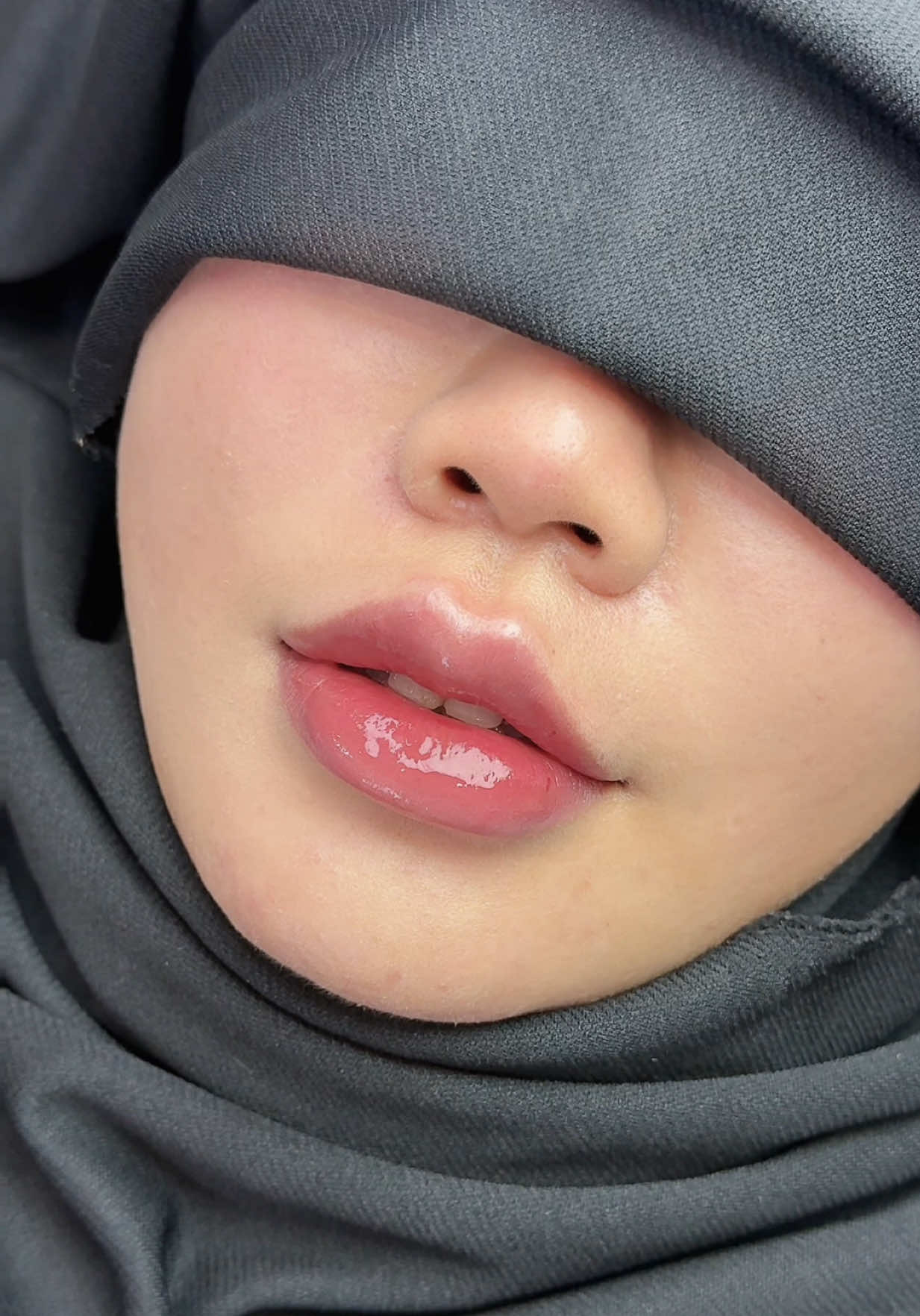 Môi xinh tại Tera, cam thường ạ #lamdep #fillermoi#moibaby #moithietke #fyp 