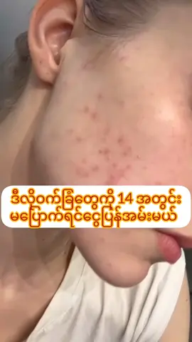 #creatorsearchinsights #09790128106vbကိုလာခဲ့ #teပျားဒန့်သလွန်မျက်နှာသစ် #အသားဖြူချင်သူများအတွက် #ဝက်ခြံပျောက်ခြင်သူများ 