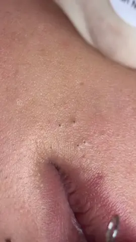 Khó #chamsocdamun#chamsocdaseo#chamsocdanam#tanbinh#Lqspa&academy