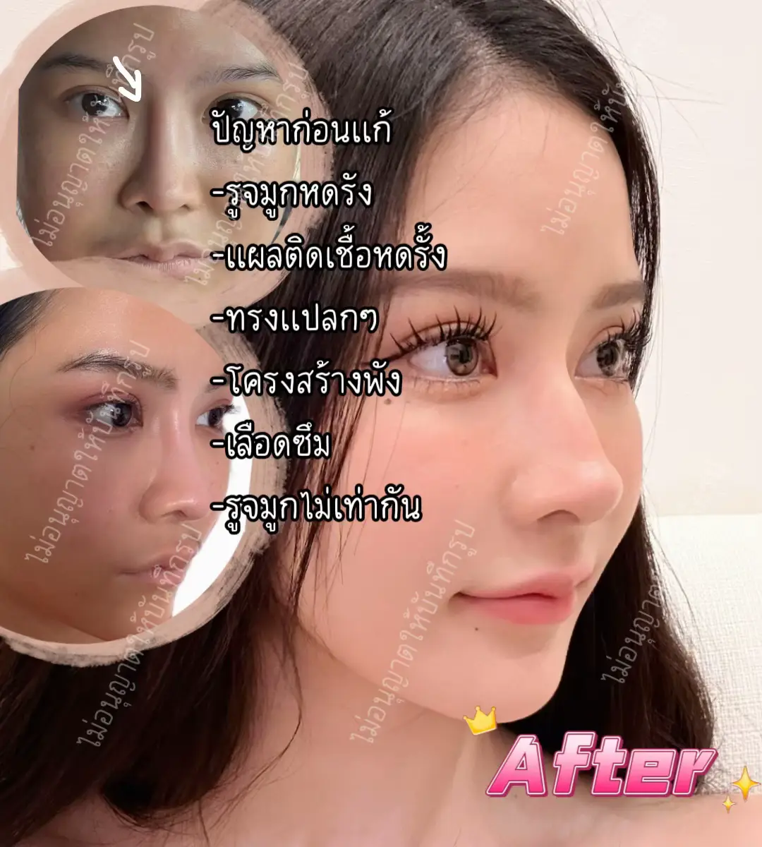 #แก้จมูก #ศัลย์จีน #ศัลยกรรมจีน #แก้จมูกที่จีน #พสจีน 