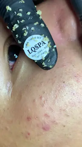 Xém #chamsocdamun#chamsocdaseo#chamsocdanam#tanbinh#Lqspa&academy