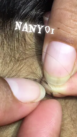 Remove lice #omg😘😘🥳🥳😭😭🤪🤪🤮🤮 #lice #loveremoval 